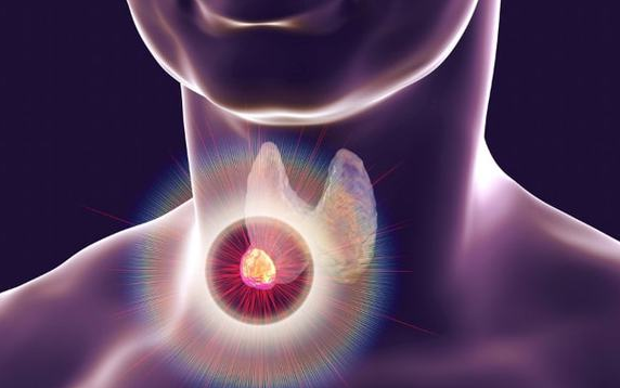美国就医：甲状腺癌的治疗指南
