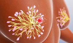 新研究发现：三阴性乳腺癌患者的TIL水平越高，生存率越高！