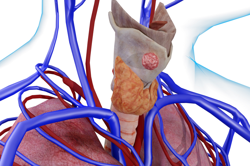 85.7%患者获益!美国新药Plixorafenib在BRAF突变甲状腺癌中展现持久疗效