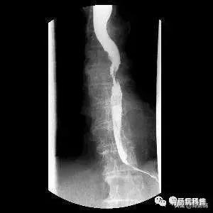 喉咙如果出现些症状，不是“咽炎”，可能是食道癌来临.jpg