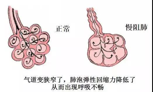 慢阻肺，被诅咒的每一次呼吸.jpg