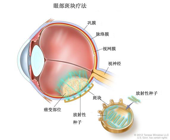 【眼内(葡萄膜 黑色素瘤治疗】治疗方案-分期疗法-nci(美国国家癌症