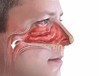 很多鼻咽癌患者都非常困惑,因为不知道自己究竟为什么会得上这种疾病