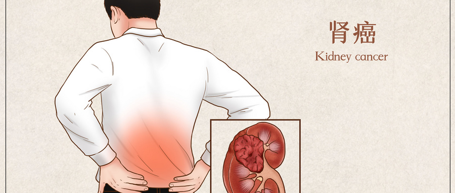 日本治疗肾癌的权威医院推荐治疗方案
