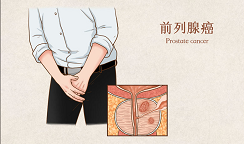 ​辉瑞PARP抑制剂组合疗法，治疗前列腺癌新研究结果喜人！