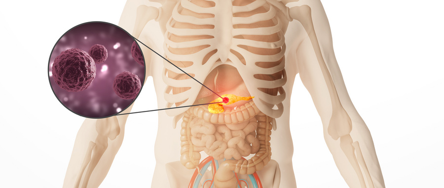 胰腺癌肝转移治疗方案需要怎么制定？胆管癌肝转移需要如何确诊？