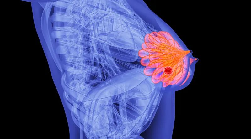 出国看病:女性如何无惧乳腺癌？2个“切忌”，1个“模式”，千万要了解！