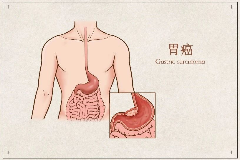 28岁青年舞蹈家抗癌8个月离世，为何又是这种癌？