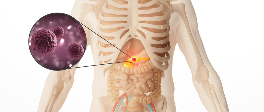 英国就医：胰腺癌治疗全程指南