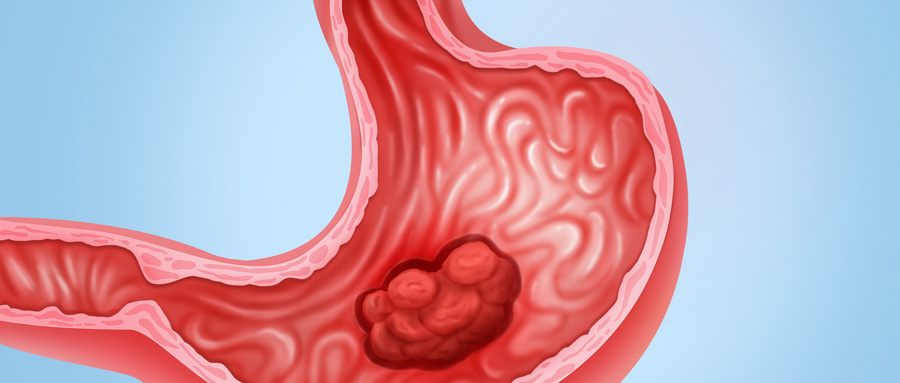 美国对胃癌转移患者有哪些蕞新治疗进展？
