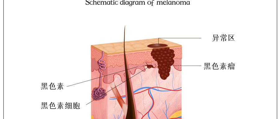 黑色素瘤.jpg