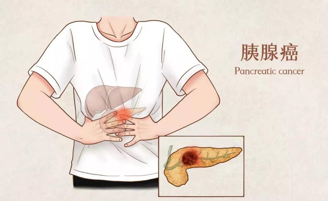 78胰腺癌.jpg
