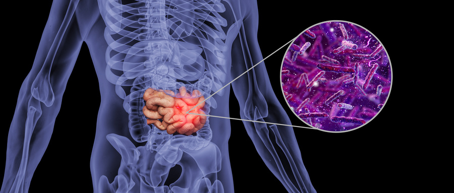 直肠癌 (3).jpg 直肠癌 (3).jpg