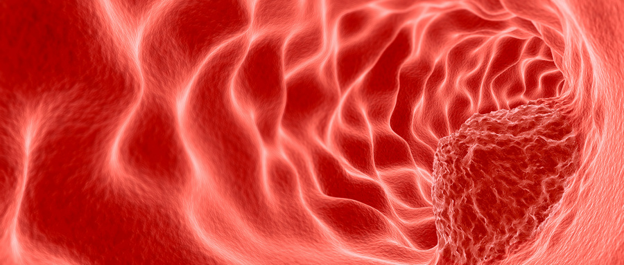 肿瘤.jpg 肿瘤.jpg