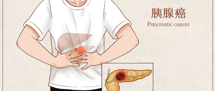 胰腺癌2.jpg 胰腺癌2.jpg