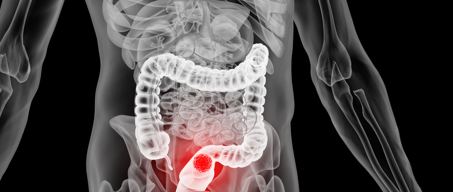 直肠癌 (2).jpg 直肠癌 (2).jpg