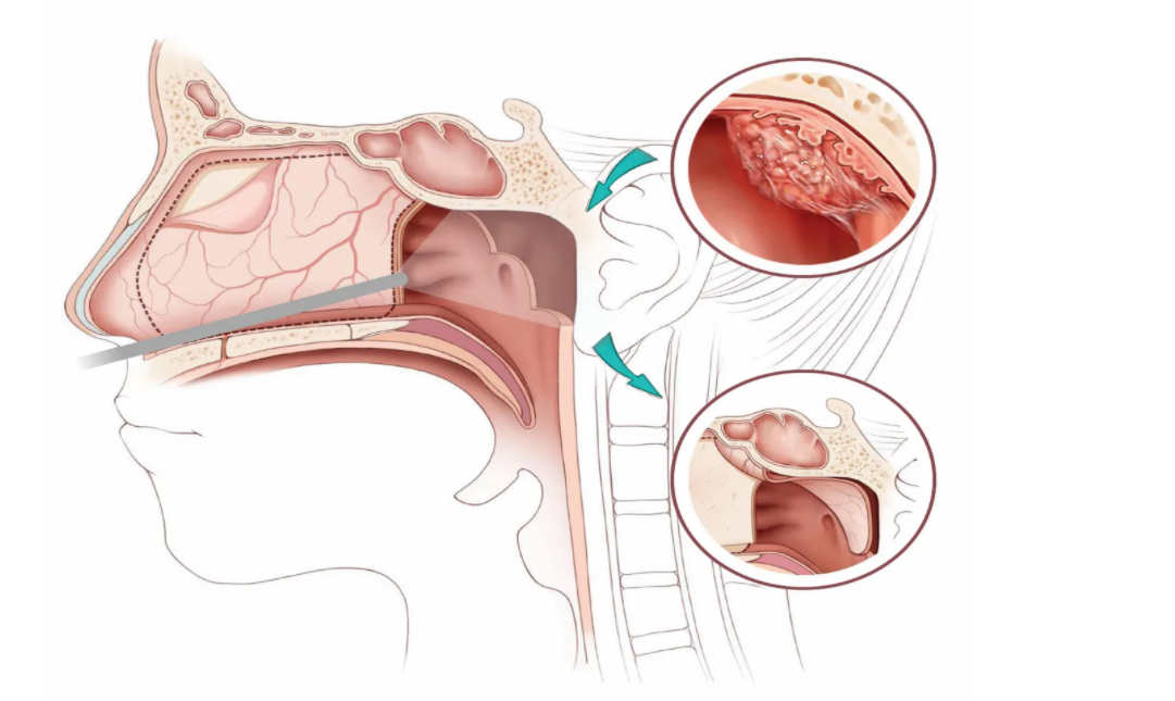 鼻咽癌.png 鼻咽癌.png