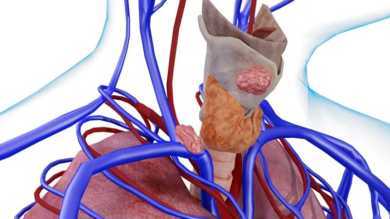 分化型甲状腺がんの治療法は何ですか?