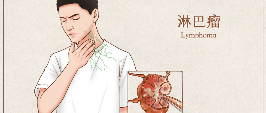 淋巴瘤.jpg