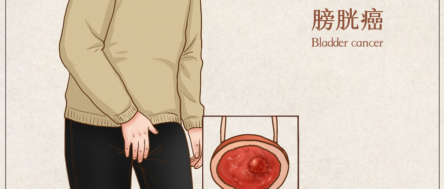 膀胱癌医疗插画（企业商用）.jpg