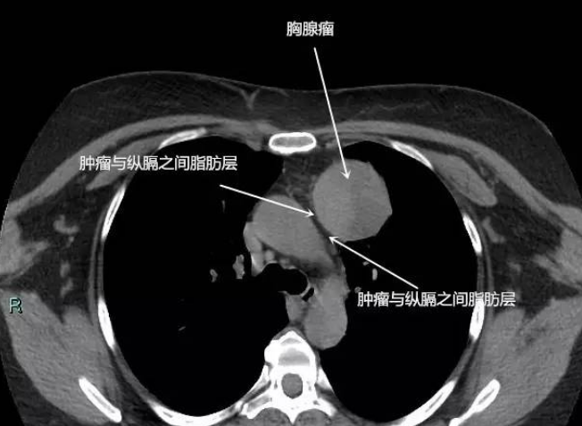 胸腺癌的病因、症状、诊断及治疗