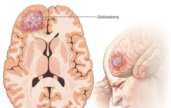 胶质母细胞瘤
