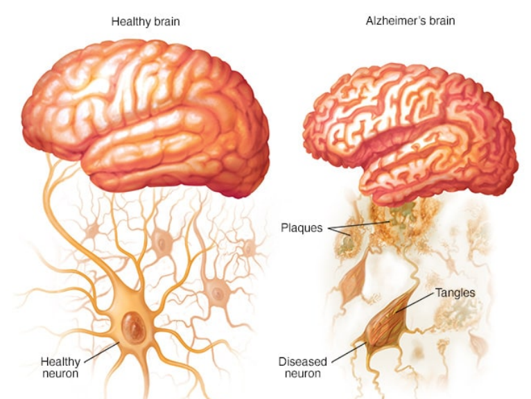 阿尔茨海默病的病因、症状及预防