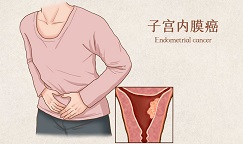 晚期子宫内膜癌联合化疗在英国获批，大幅提升患者生存率！