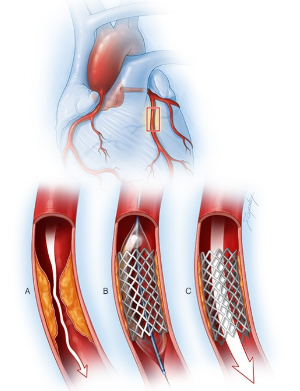 冠状动脉支架