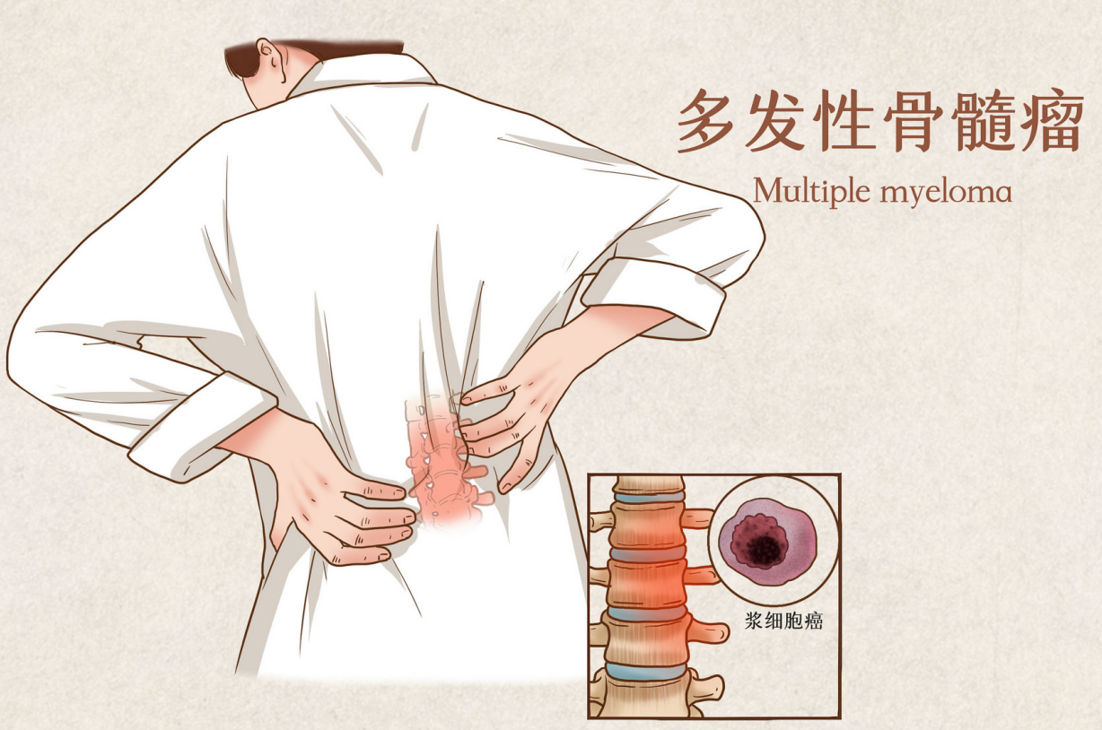 海外骨髓瘤治疗新方案