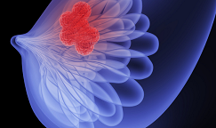对话美国耶鲁癌症中心主任：各类乳腺癌有了哪些前沿研究进展？