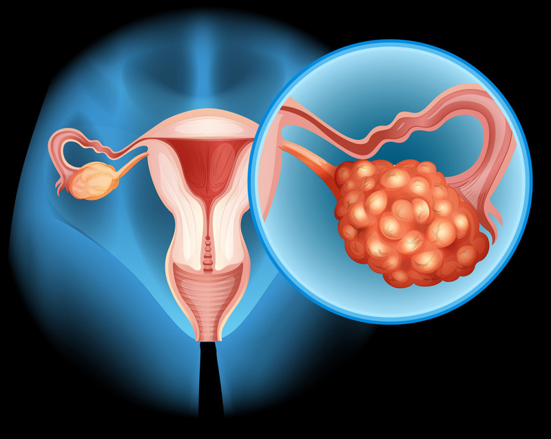 美国治疗浆液性卵巢癌就医流程