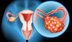 过半患者肿瘤大幅缩小或消失，美国溶瘤病毒联合疗法治疗卵巢癌给力！