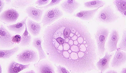 新发现：“BRCA样”表型三阴性乳腺癌或可使用PARP抑制剂治疗