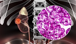免疫联合方案一线治疗晚期肾癌，超一半患者肿瘤缩小或消失！