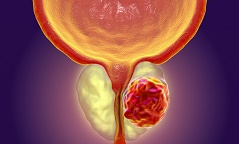 ​前列腺癌前沿药Rubraca数据喜人，让肿瘤稳定时间大幅延长！