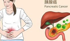 胰腺癌患者的免疫反应存在性别差异，原因或已被找到