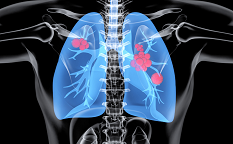 ​肺癌STK11基因突变靶向药研究：头位患者已开始用药