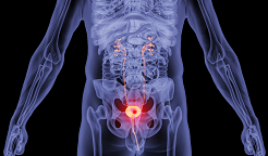 ​膀胱癌一线疗法获批！68%的患者肿瘤大幅缩小！