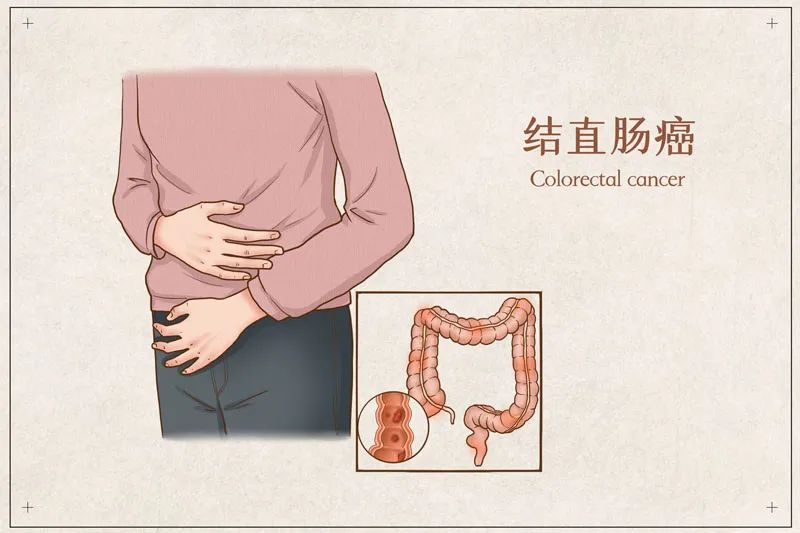 加州大学旧金山分校医疗中心治疗结直肠癌怎么样？