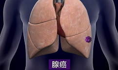 日本肺癌五年生存率领跑全球！镜头直击一场真实的肺癌手术