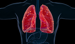 有效率高达91%，67%的患者肿瘤大幅缩小或消失！肺癌新疗法强势来袭