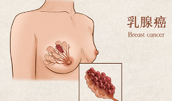 前沿联合疗法，显著延长晚期乳腺癌患者病情稳定时长！
