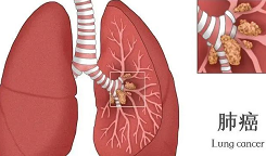肺癌术后干咳不断，还查出肺结节，难道是复发？听听权威专家怎么说！