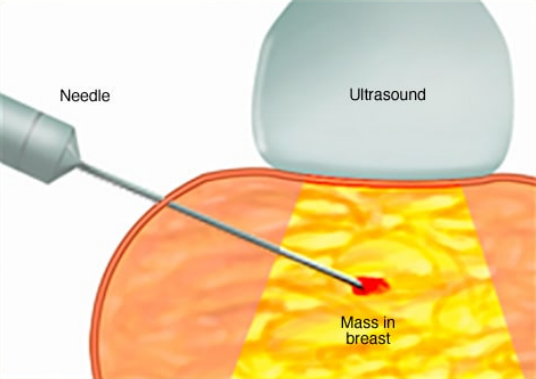 乳腺癌诊断