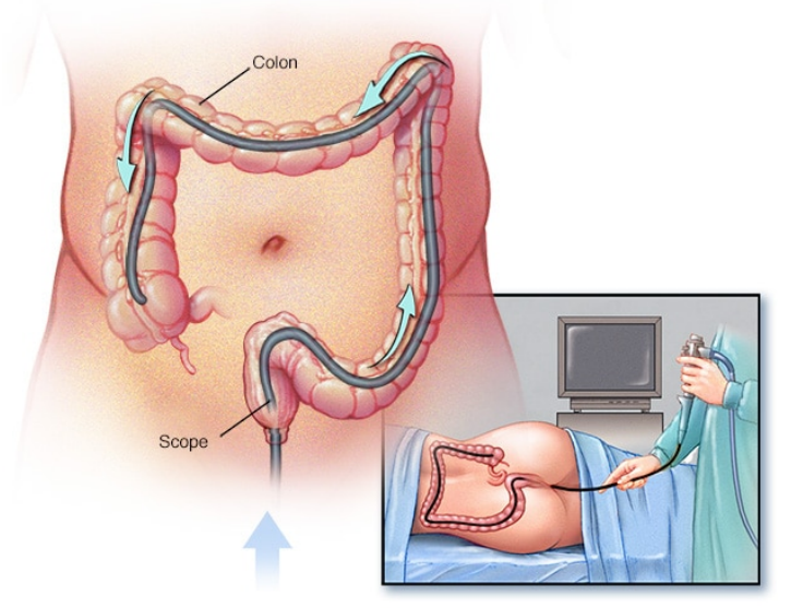 结肠镜检查