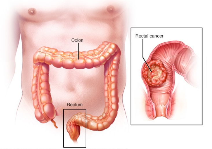 直肠癌的病因和症状