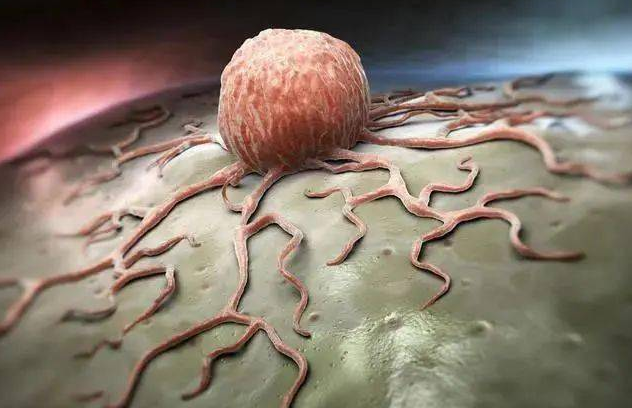 软组织肉瘤的症状、病因和治疗方案