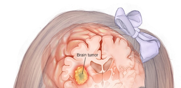 小儿脑肿瘤
