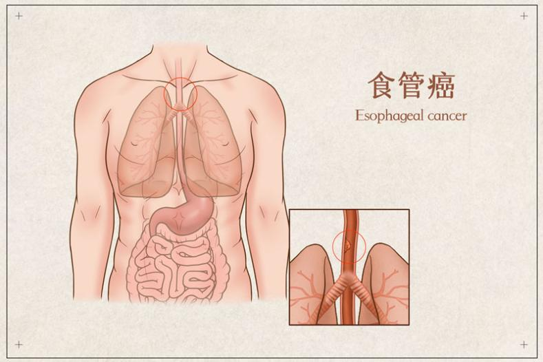 日本看病：日本治疗食管癌的优势和医院推荐